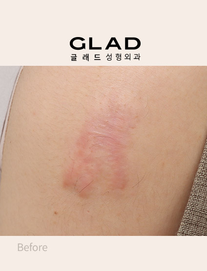 켈로이드 치료 전 돌출된 흉터 모습