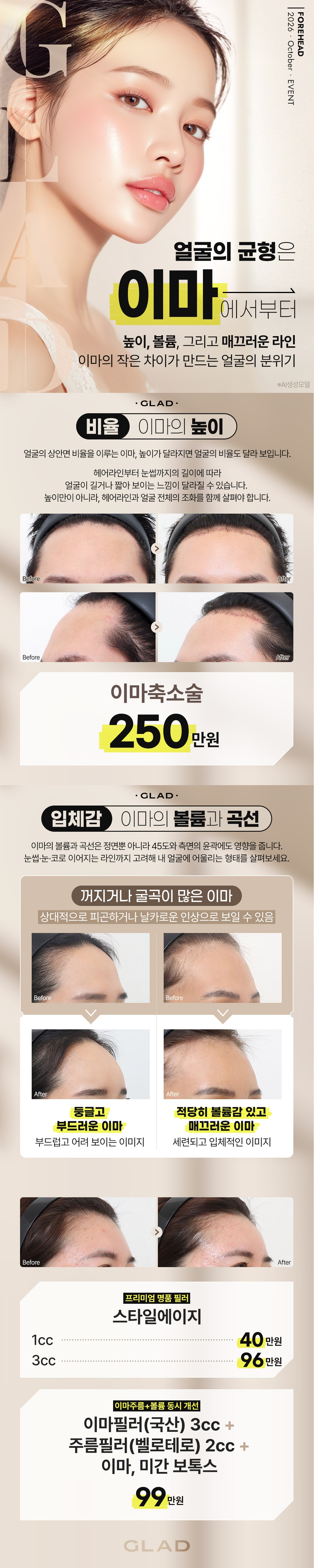 글래드성형외과 2026년 10월 이마 이벤트 안내: 이마축소수술 250만원, 이마필러 및 이마·미간 보톡스